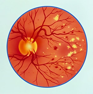 Artwork of diabetic retinopathy ophthalmoscope view Artwork of diabetic retinopathy ophthalmoscope view