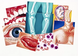 Artwork of disorders due to vitamin deficiencies Artwork of disorders due to vitamin deficiencies