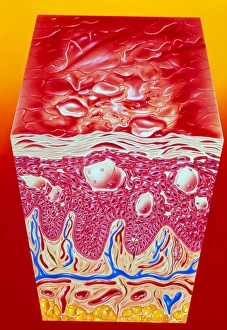 Artwork of eczema in section of skin epidermis Artwork of eczema in section of skin epidermis