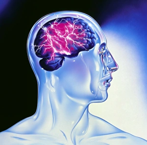 Artwork of epilepsy seen as lightning in brain Artwork of epilepsy seen as lightning in brain