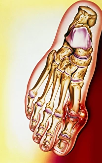 Artwork of gout: tophus at base of the big toe Artwork of gout: tophus at base of the big toe