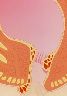 Artwork of internal and external haemorrhoids Artwork of internal and external haemorrhoids