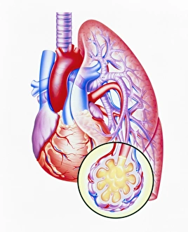 Artwork of lung oedema in heart failure Artwork of lung oedema in heart failure