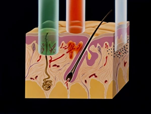 Artwork: penetration of skin by various lasers Artwork: penetration of skin by various lasers