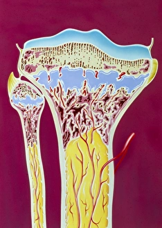 Artwork of rickets in tibia and fibula bones Artwork of rickets in tibia and fibula bones