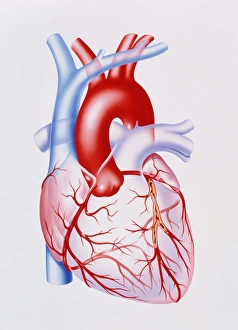 Artwork showing atherosclerosis of coronary artery Artwork showing atherosclerosis of coronary artery