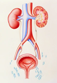 Artwork showing cystitis leading to pyelonephritis Artwork showing cystitis leading to pyelonephritis