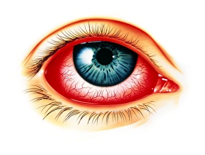 Artwork showing eye with allergic conjunctivitis Artwork showing eye with allergic conjunctivitis