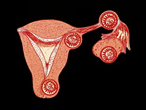 Artwork showing multiple ectopic pregnancies Artwork showing multiple ectopic pregnancies