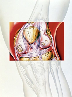 Artwork showing rheumatoid arthritis of the knee Artwork showing rheumatoid arthritis of the knee