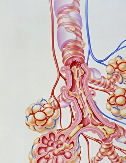 Artwork of sputum in lungs with chronic bronchitis Artwork of sputum in lungs with chronic bronchitis