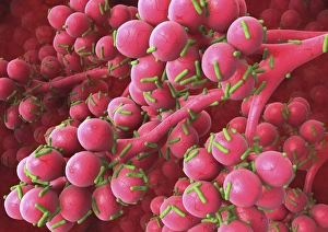Bacterial lung infection Print