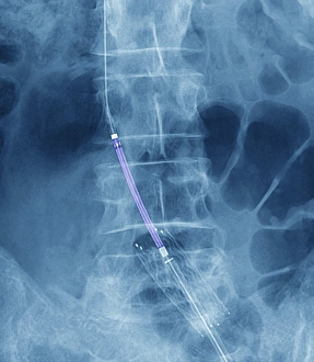 Coloured X-ray Print of Balloon Angioplasty