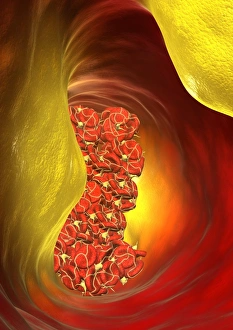 Blocked Artery Print