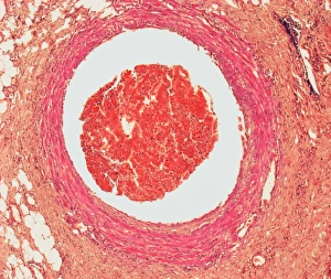 Blood Clotting Process Prints: Blood clot, light micrograph