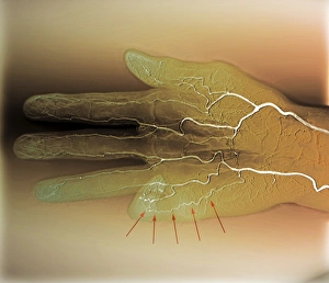 Blood supply of the hand, angiogram C018/0387 Blood supply of the hand, angiogram C018/0387