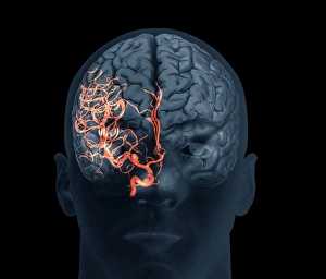 Prints of Brain aneurysm. 3D computed tomography (CT) angiogram coupled with a magnetic resonance imaging (MRI) scan of the brain of a 38-year-old, showing a large aneurysm (bright) Images Dated 2013 April: 3D CT Angiogram Print of a Brain Aneurysm