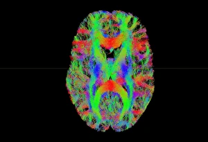 Brain fibres, tract density imaging C017/7039 Brain fibres, tract density imaging C017/7039