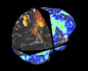 Brain tumour, fMRI and tractography C017/7102 Brain tumour, fMRI and tractography C017/7102