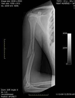 Medical Imaging Technology Prints: Broken arm bone, digital X-ray