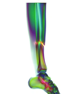 Broken leg Broken leg