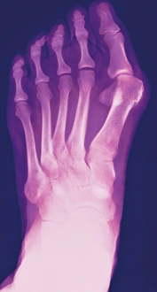 Prints of Bunion. Coloured X-ray of a bunion (hallux valgus, upper right), the swelling of the joint between the big toe and the first metatarsal bone in the foot Images Dated 2008 June: Colour X-ray Print of a Bunion