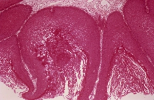 Light Microscopy Images Prints: Cervical wart, light micrograph C015 / 6055