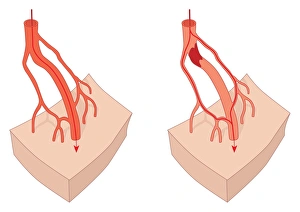 Circulatory System Artwork Prints: Collateral circulation, artwork