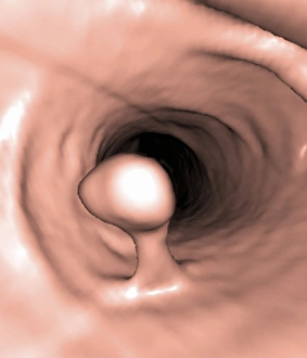 Images Dated 4th March 2013: 10mm Pedunculated Colon Polyp Print