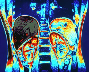 Colour MRI scan of abdomen showing kidneys & liver Colour MRI scan of abdomen showing kidneys & liver