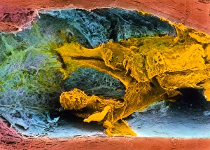 Colour SEM of atherosclerosis in coronary artery Colour SEM of atherosclerosis in coronary artery