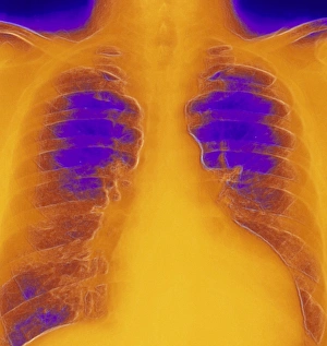 Coloured chest X-ray of ventricular cardiomyopathy Coloured chest X-ray of ventricular cardiomyopathy