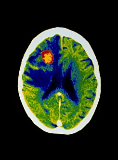Coloured CT scan of brain abscess in AIDS patient Coloured CT scan of brain abscess in AIDS patient