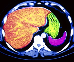 Coloured CT scan of human spleen, stomach and liver Coloured CT scan of human spleen, stomach and liver