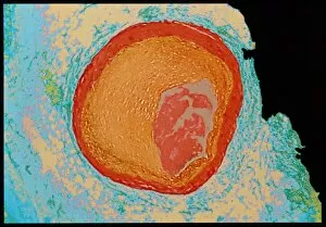 Images Dated 11th April 1996: Coloured LM of occluded human coronary artery