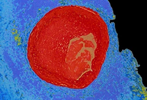 Coloured LM of occluded human coronary artery Coloured LM of occluded human coronary artery