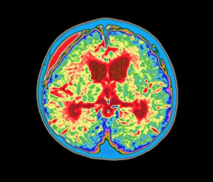 Coloured MRI brain scan of abscess in meningitis Coloured MRI brain scan of abscess in meningitis