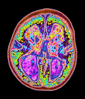 Coloured MRI brain scan showing lissencephaly Coloured MRI brain scan showing lissencephaly