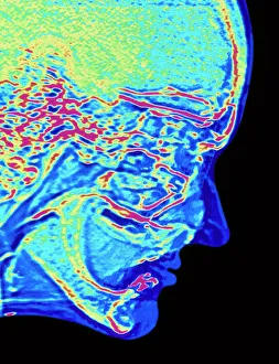 Coloured MRI scan of healthy human head in profile Coloured MRI scan of healthy human head in profile