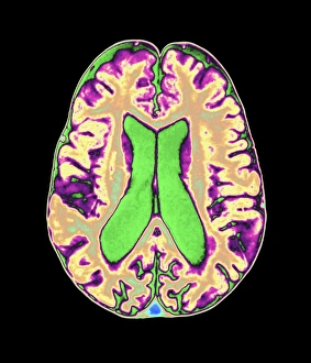 Coloured MRI scan of organophosphate brain damage