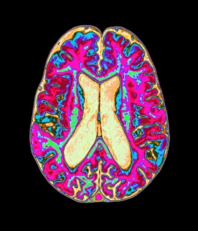 Coloured MRI scan of organophosphate brain damage
