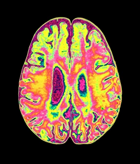 Coloured MRI scan of organophosphate brain damage
