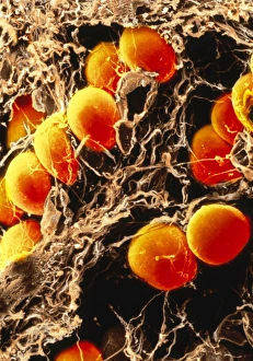 Coloured SEM of fat cells in adipose tissue Coloured SEM of fat cells in adipose tissue