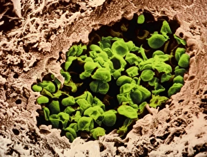 Coloured SEM of Pneumocystis carinii in AIDS lung Coloured SEM of Pneumocystis carinii in AIDS lung