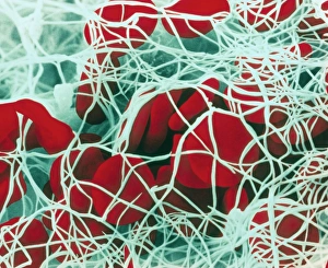 Coloured SEM of red blood cells forming a clot Coloured SEM of red blood cells forming a clot