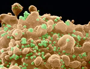 Coloured SEM of a T-cell infected with AIDS virus Coloured SEM of a T-cell infected with AIDS virus