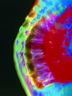 Coloured X-ray of curved spine in osteoporosis Coloured X-ray of curved spine in osteoporosis