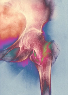 Coloured X-ray of femur fracture in osteoporosis Coloured X-ray of femur fracture in osteoporosis