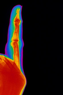 Coloured X-ray of finger with rheumatoid arthritis Coloured X-ray of finger with rheumatoid arthritis