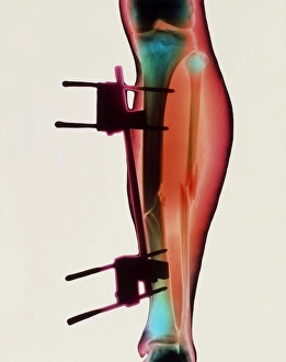 Coloured X-ray of a fractured tibia & fibula Coloured X-ray of a fractured tibia & fibula